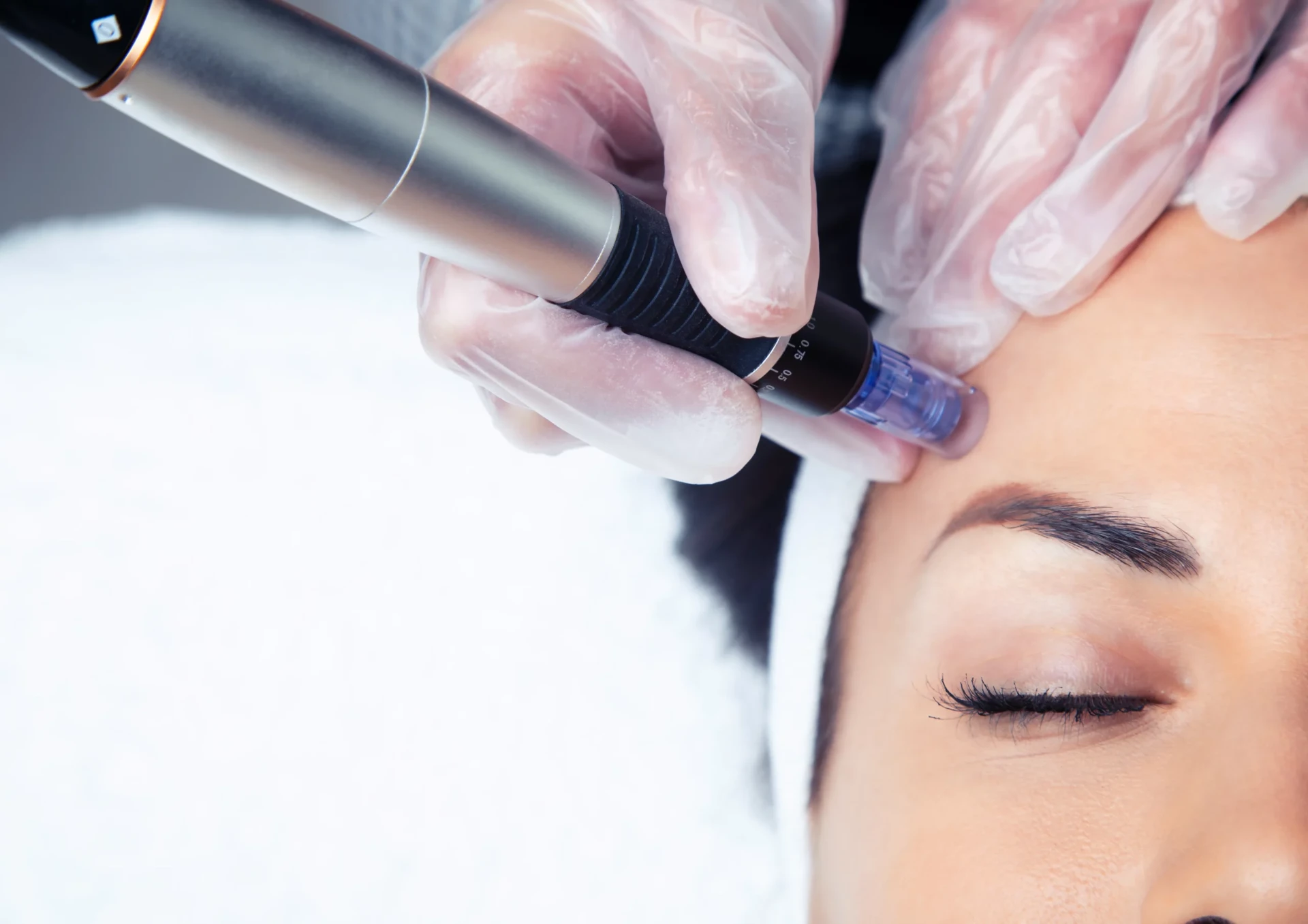 Bild från arbete med Microneedling i Enköping hos Carinas Hudvård